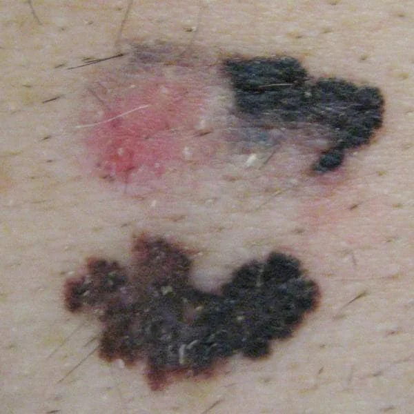 Melanoom: A-symmetrie