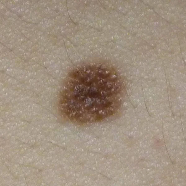 Moedervlek: Symmetrie