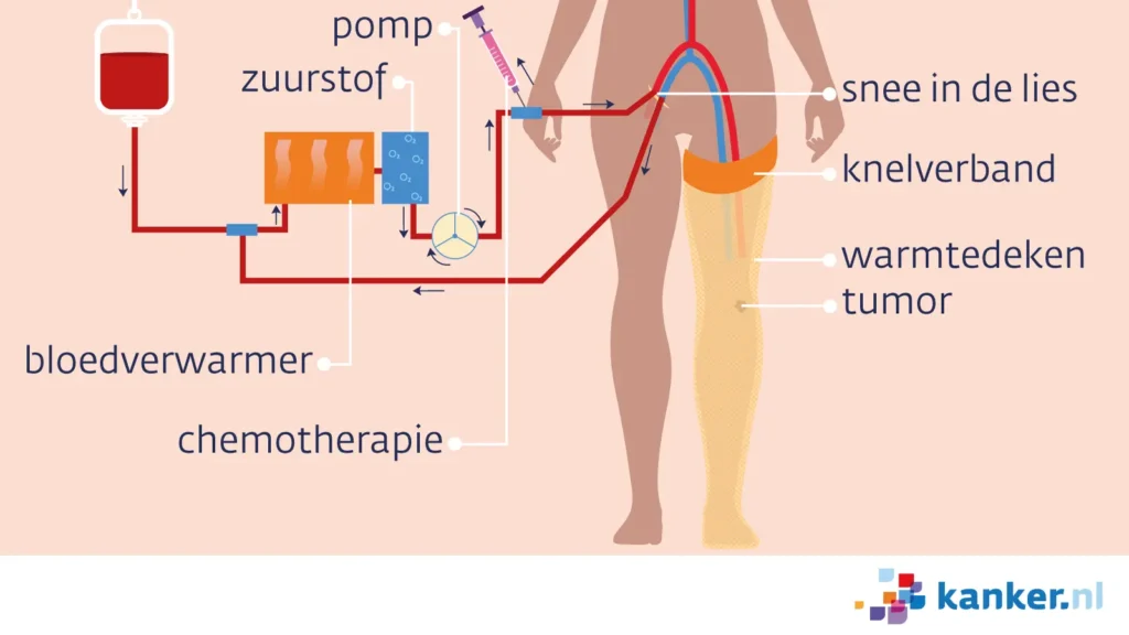 Ge:isoleerde ledematen perfusie