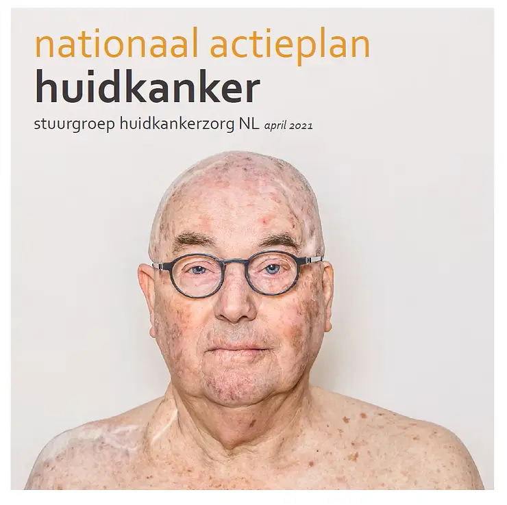 nationaal actieplan huidmelanoom