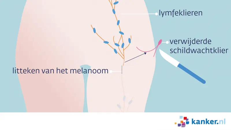 Verwijderde schildwachtklier
